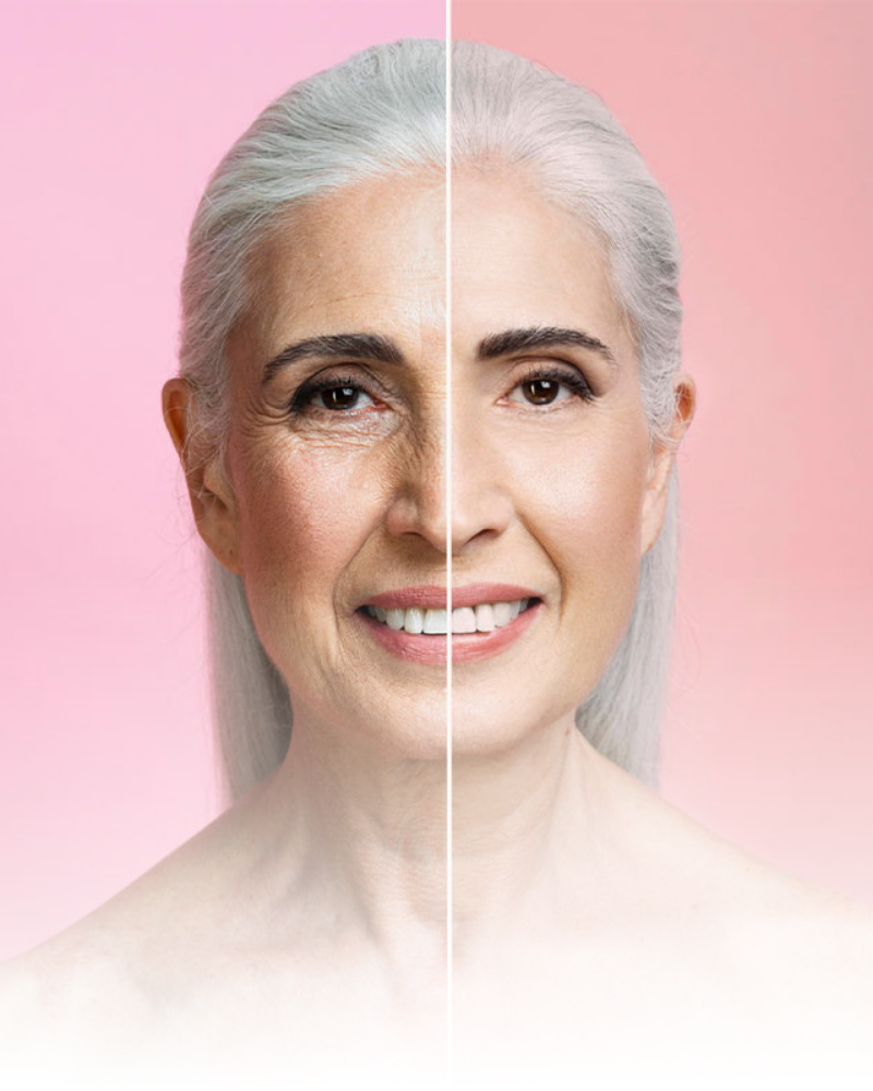 Tratamiento arrugas, envejecimiento, antiaging, manchas cutáneas