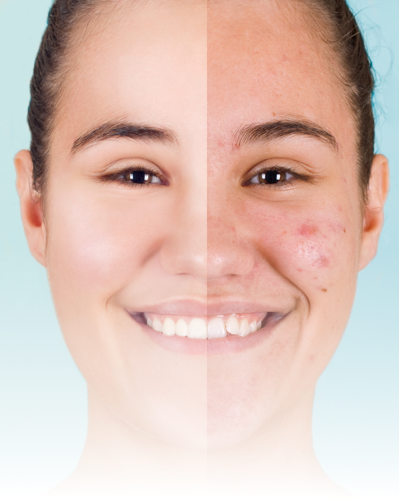 Higiene facial, tratamientos acné, marcas acné, cicatrices